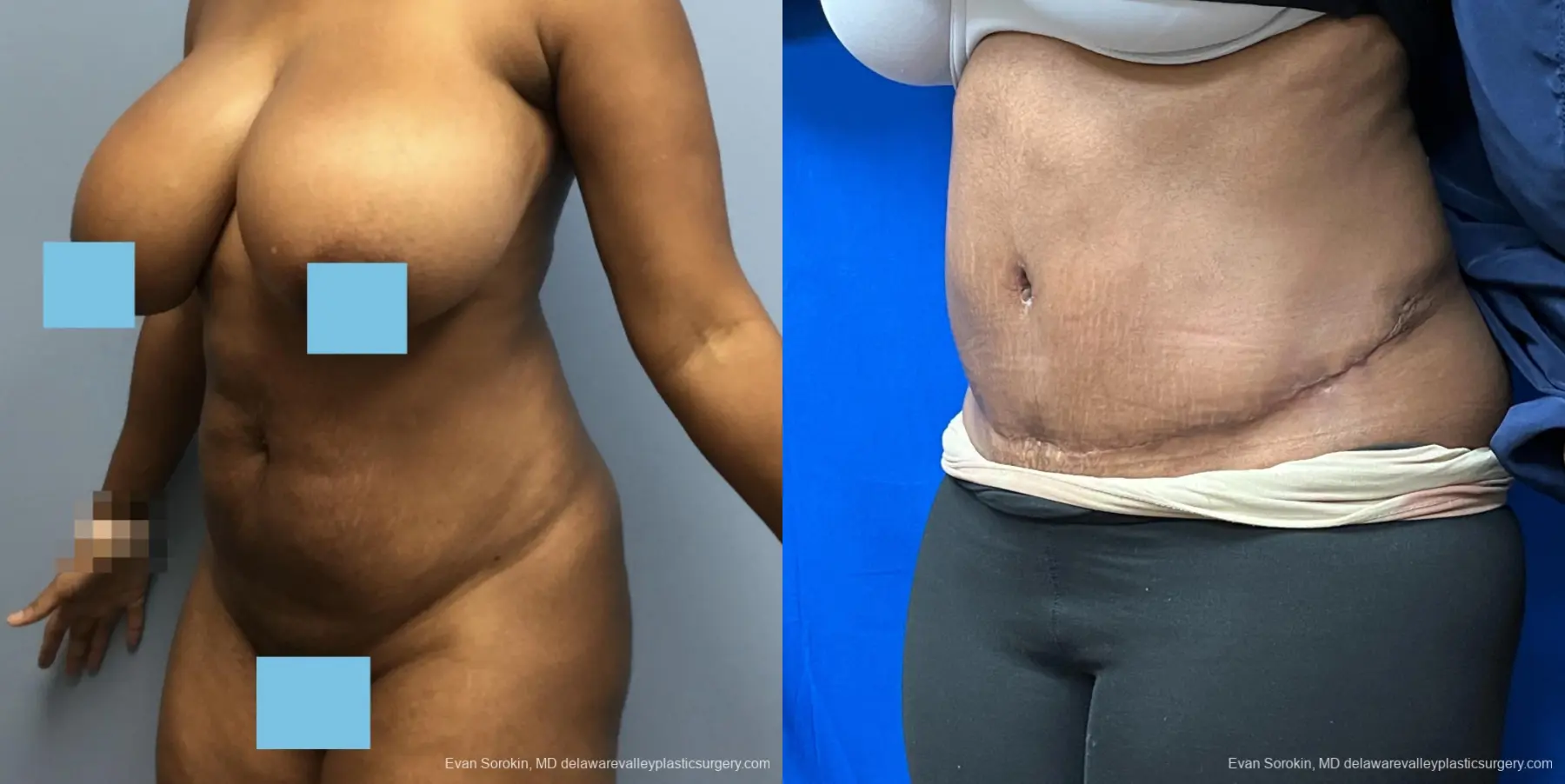 Abdominoplasty: Patient 39 - Before and After 4