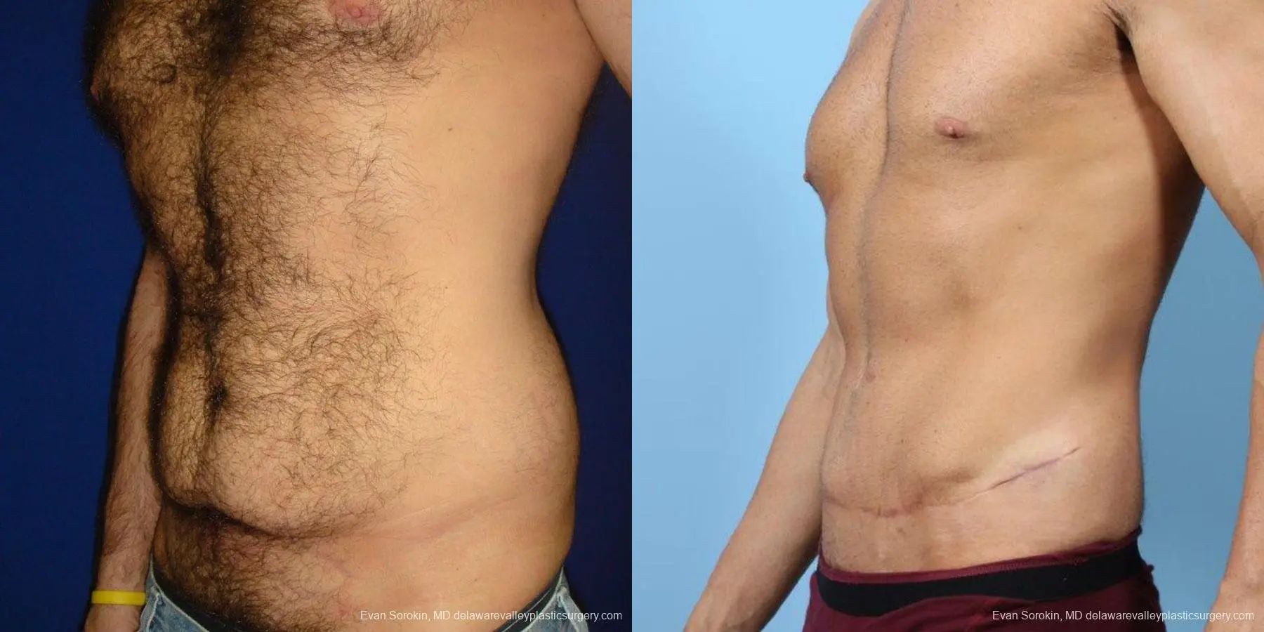 Philadelphia Abdominoplasty 9468 - Before and After 4