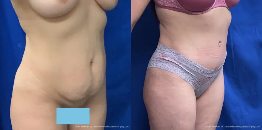 Abdominoplasty: Patient 36 - Before and After 2