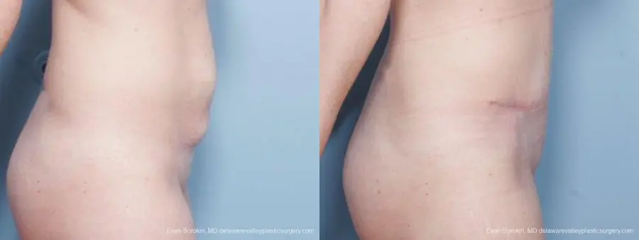 Philadelphia Abdominoplasty 9476 - Before and After 3