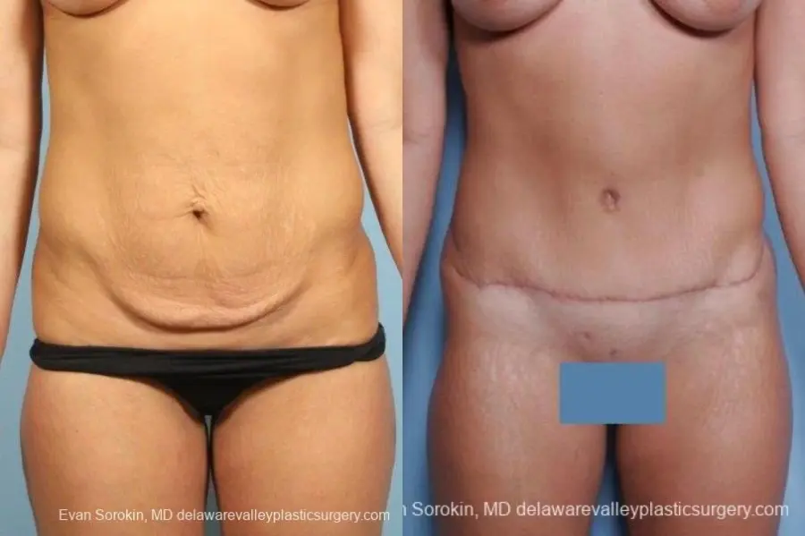 Philadelphia Abdominoplasty 8698 - Before and After 1