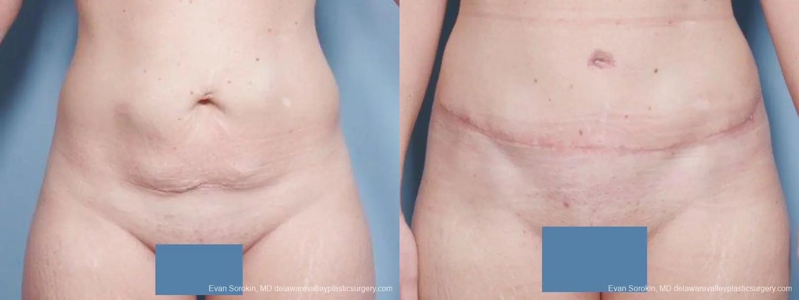 Philadelphia Abdominoplasty 9476 - Before and After 1