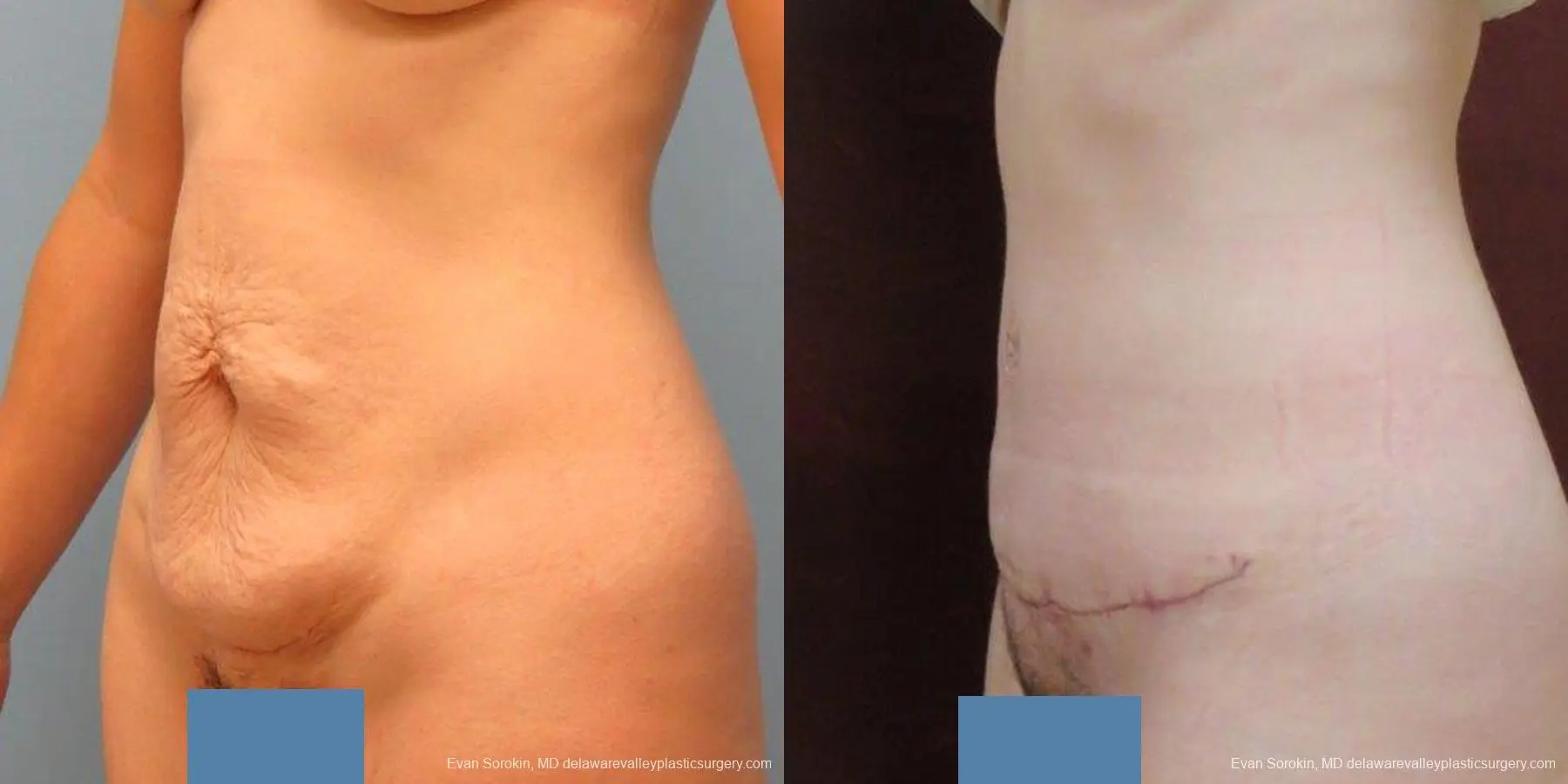 Philadelphia Abdominoplasty 9465 - Before and After 4