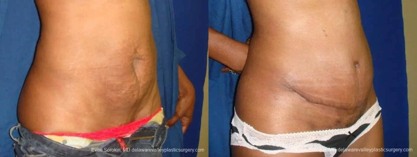 Philadelphia Abdominoplasty 8707 - Before and After 3