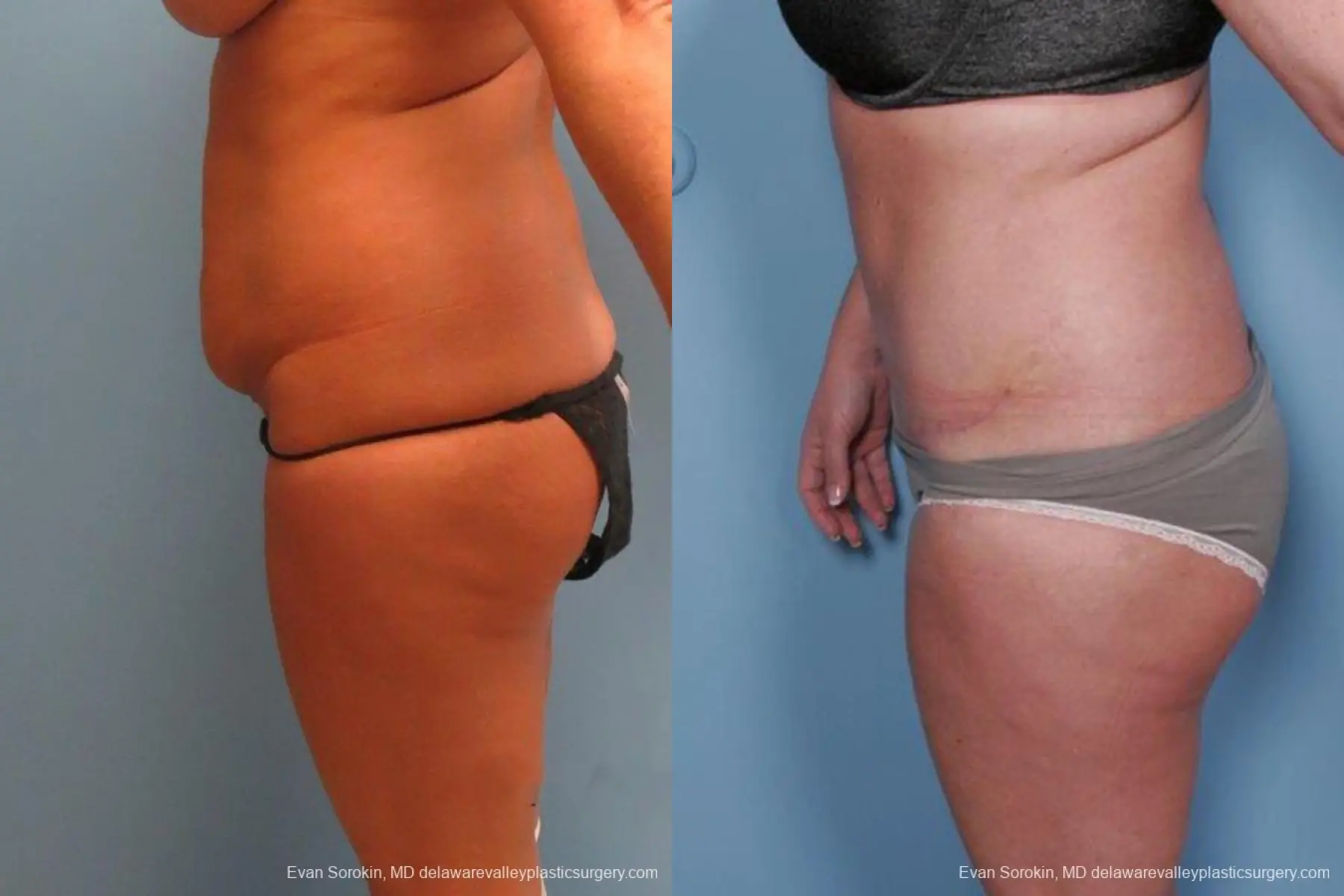Philadelphia Abdominoplasty 9463 - Before and After 5