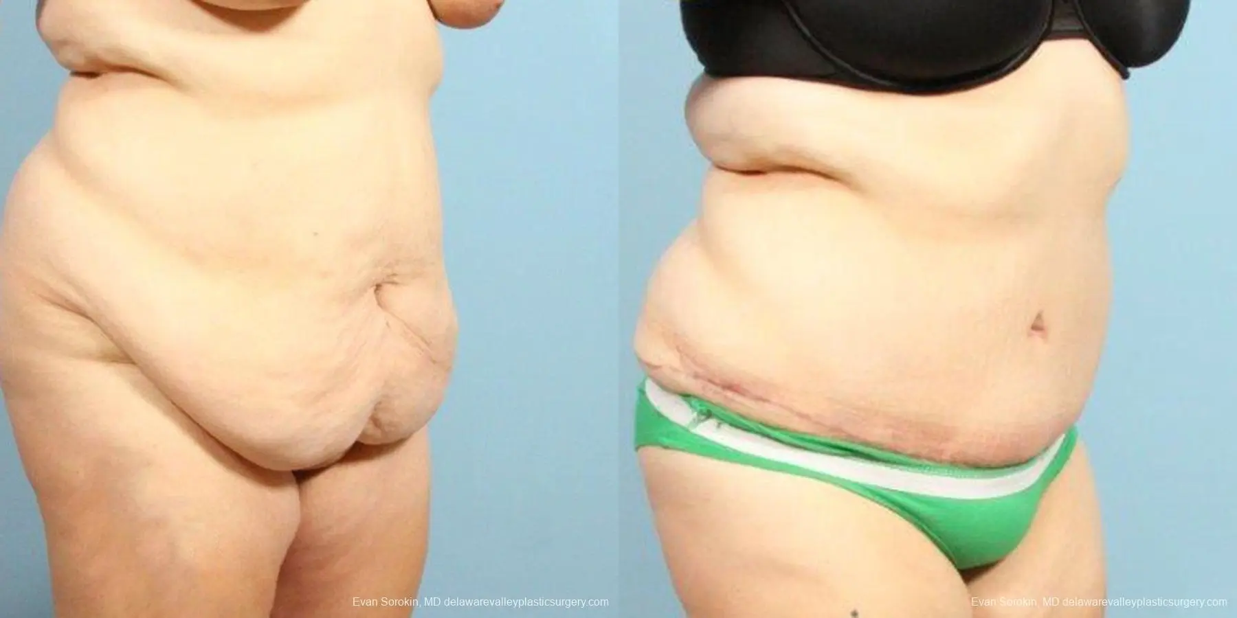 Philadelphia Abdominoplasty 9466 - Before and After 2