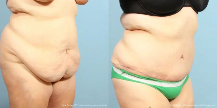 Philadelphia Abdominoplasty 9466 - Before and After 2