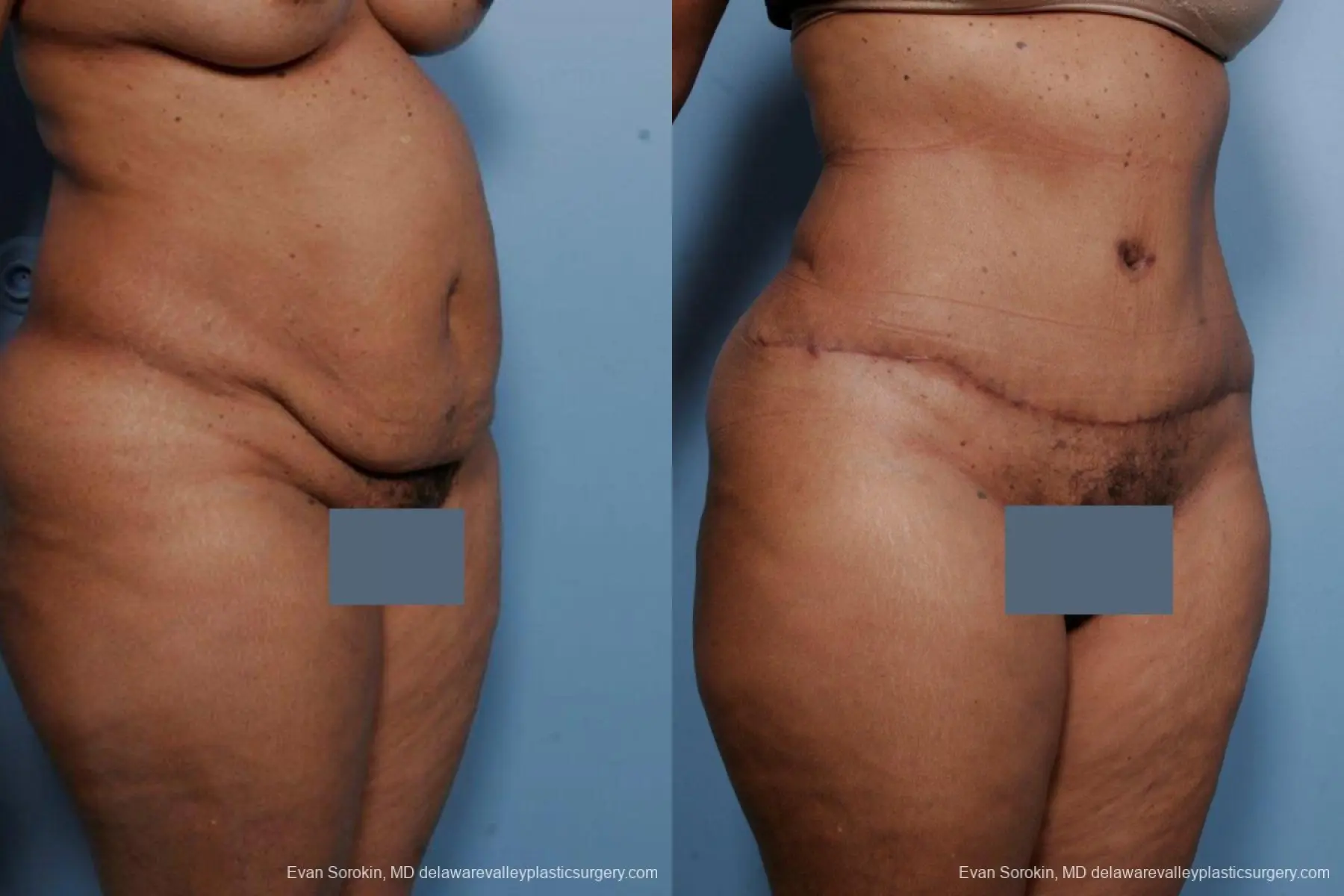 Philadelphia Abdominoplasty 9461 - Before and After 2