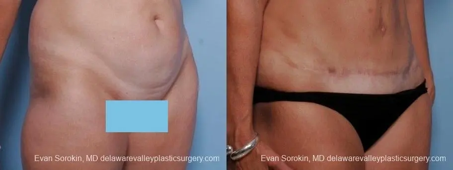 Philadelphia Abdominoplasty 8682 - Before and After 2