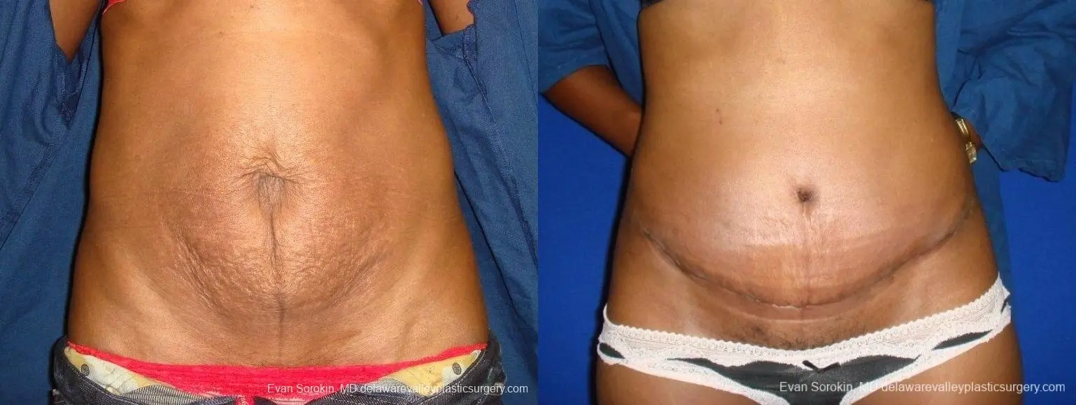 Philadelphia Abdominoplasty 8707 - Before and After 1