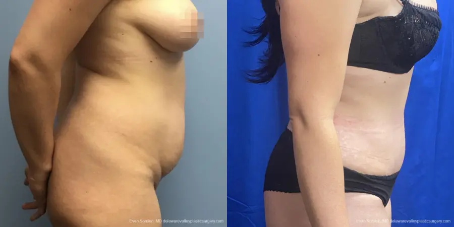 Abdominoplasty: Patient 35 - Before and After 3