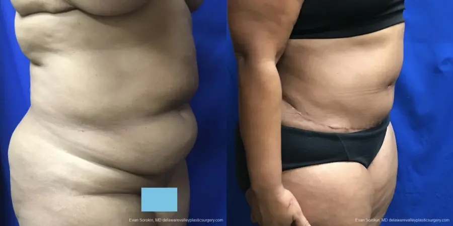 Abdominoplasty: Patient 34 - Before and After 2
