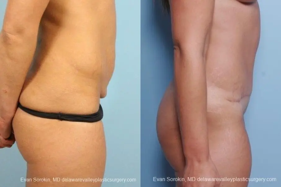 Philadelphia Abdominoplasty 8698 - Before and After 4