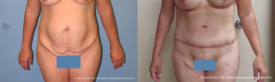 Philadelphia Abdominoplasty 10122 - Before and After 1