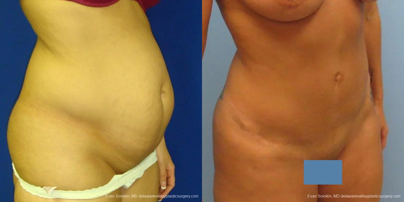 Philadelphia Abdominoplasty 9475 - Before and After 2