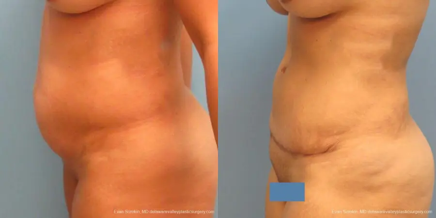 Philadelphia Abdominoplasty 9478 - Before and After 3