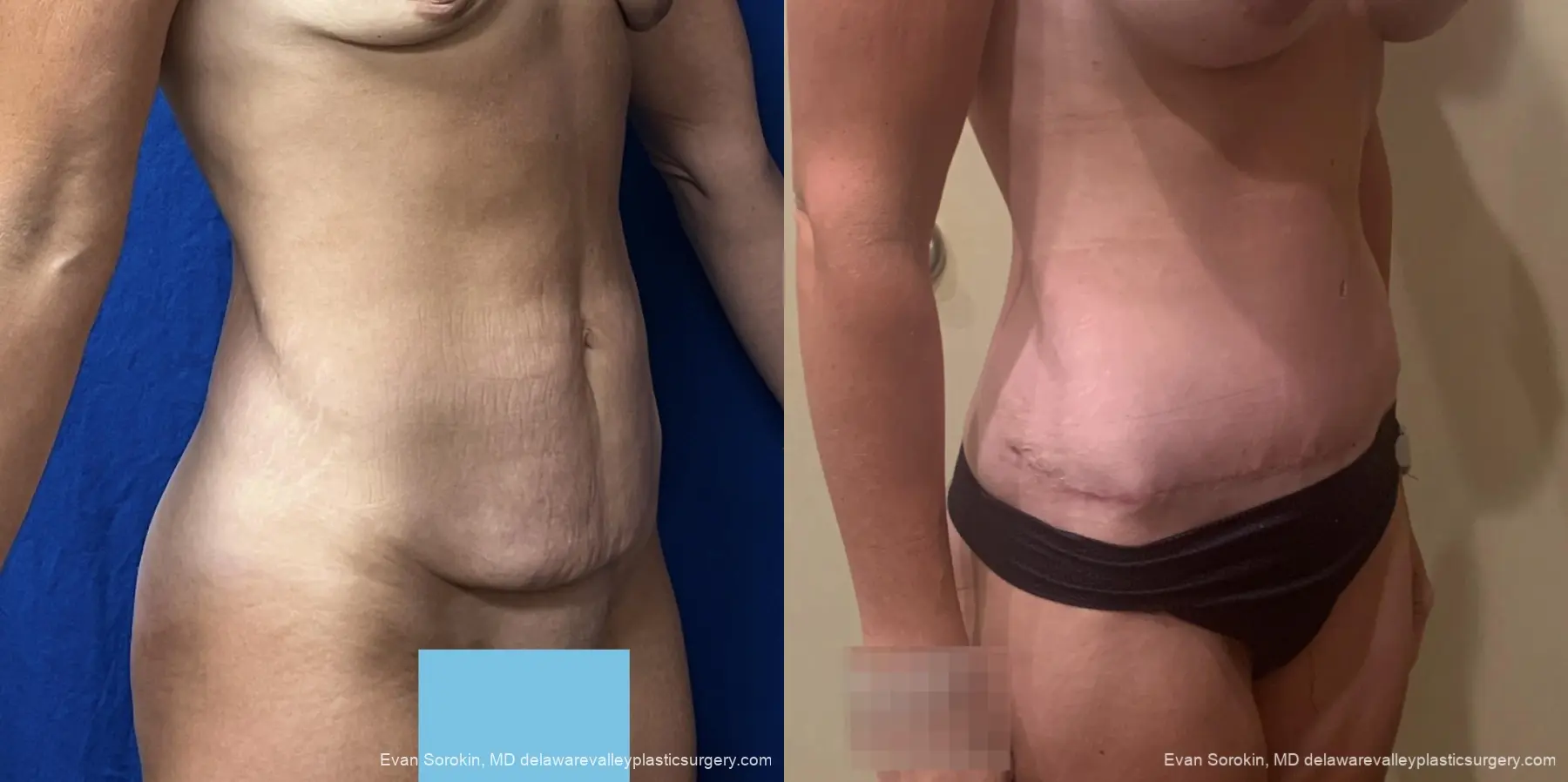 Abdominoplasty: Patient 3 - Before and After 2
