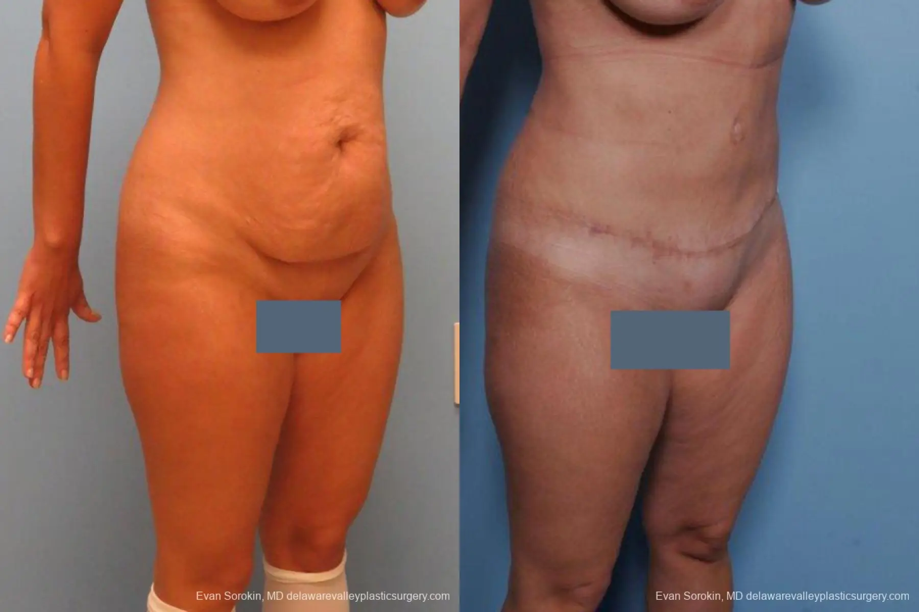 Philadelphia Abdominoplasty 9460 - Before and After 2