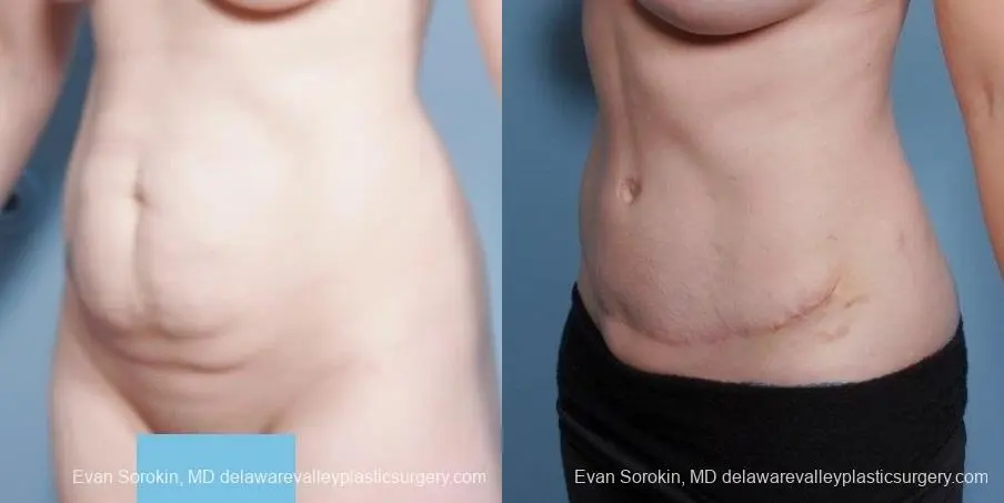 Philadelphia Abdominoplasty 8681 - Before and After 3