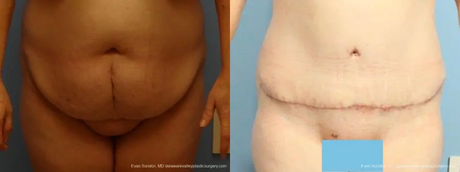 Philadelphia Abdominoplasty 9467 - Before and After 1