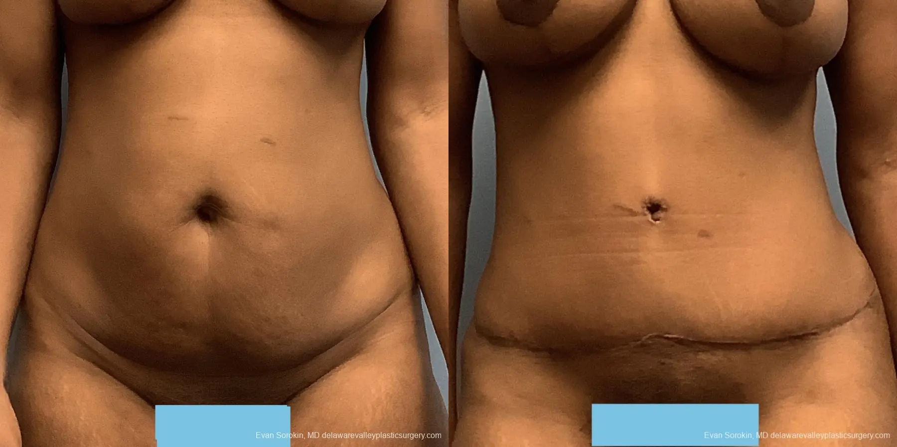 Abdominoplasty: Patient 33 - Before and After 1