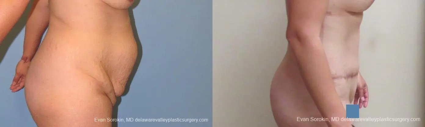 Philadelphia Abdominoplasty 10122 - Before and After 3