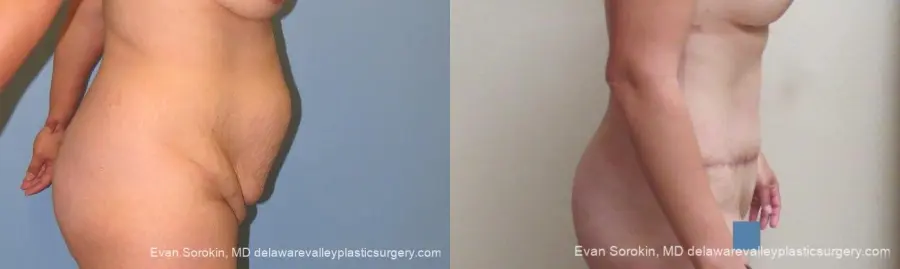 Philadelphia Abdominoplasty 10122 - Before and After 3