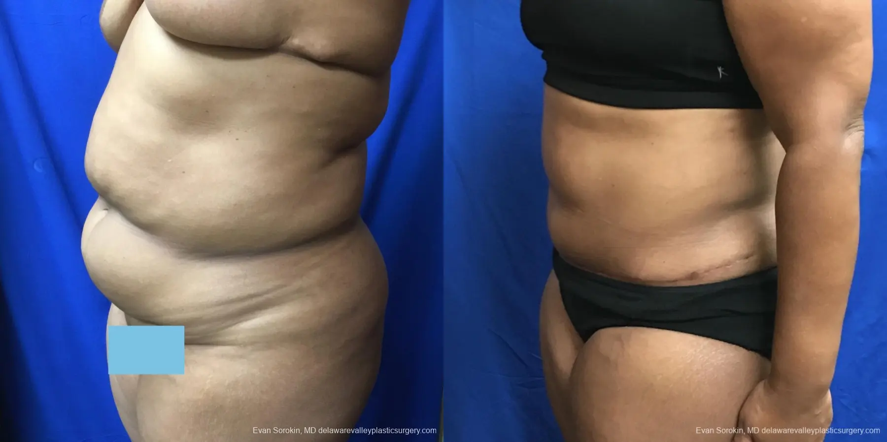 Abdominoplasty: Patient 34 - Before and After 4