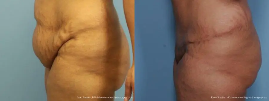 Philadelphia Abdominoplasty 9462 - Before and After 5