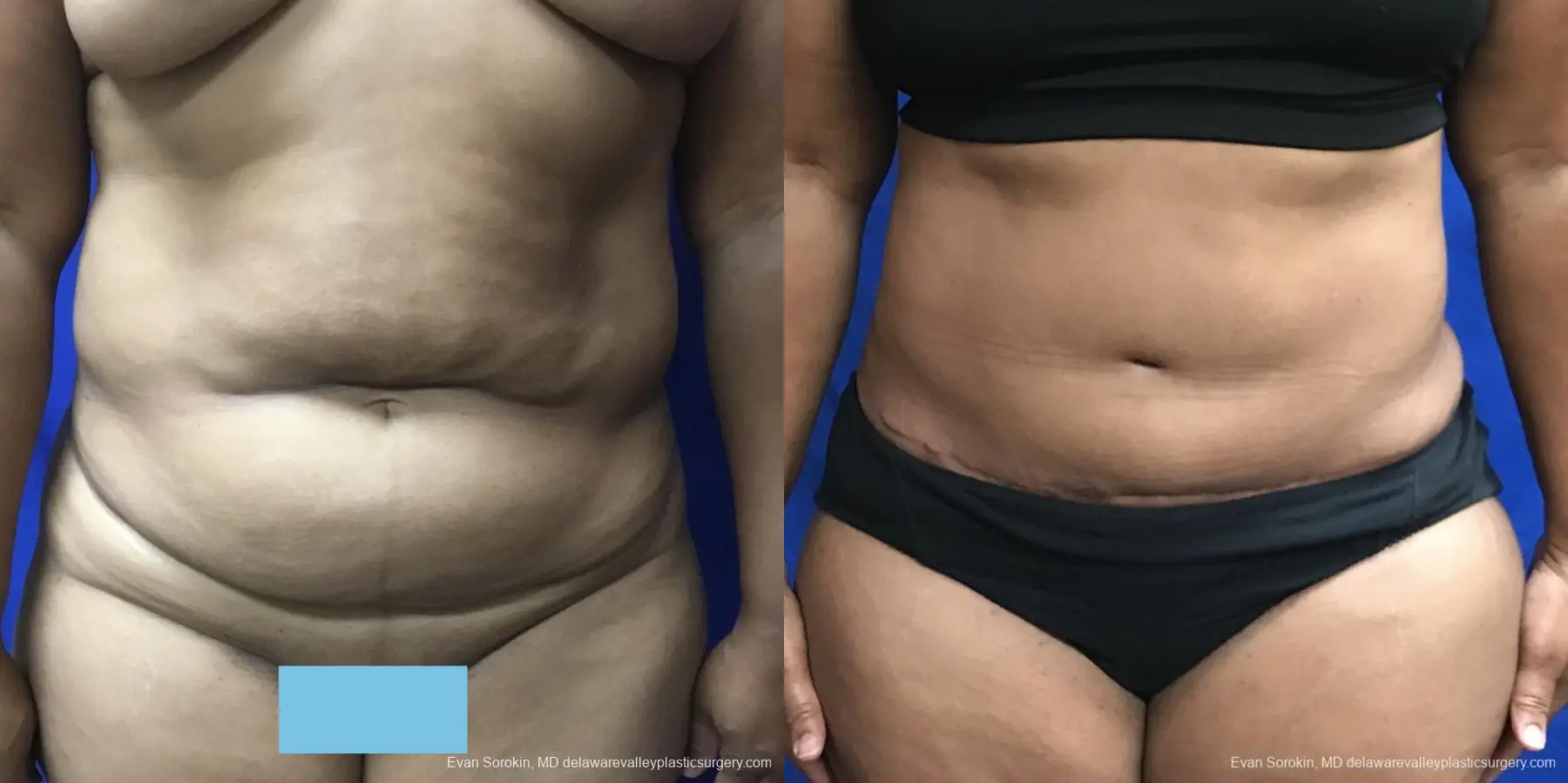Abdominoplasty: Patient 34 - Before and After 1