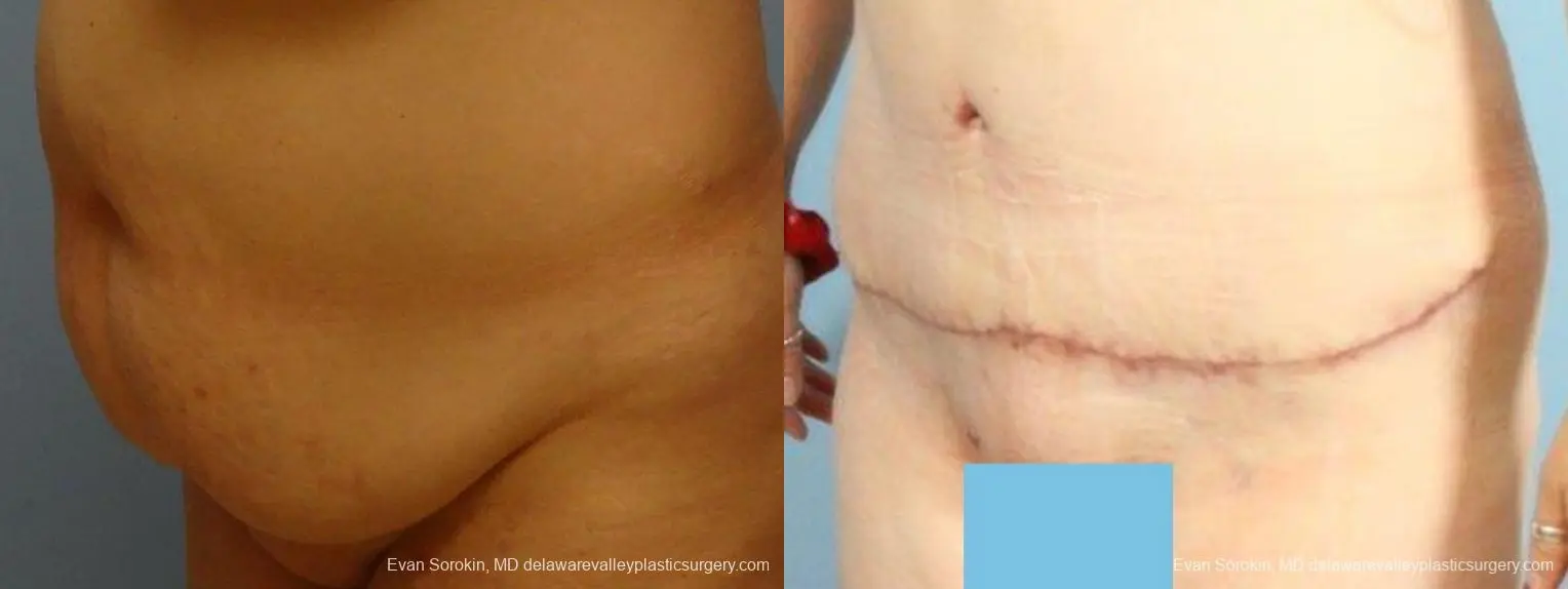 Philadelphia Abdominoplasty 9467 - Before and After 4