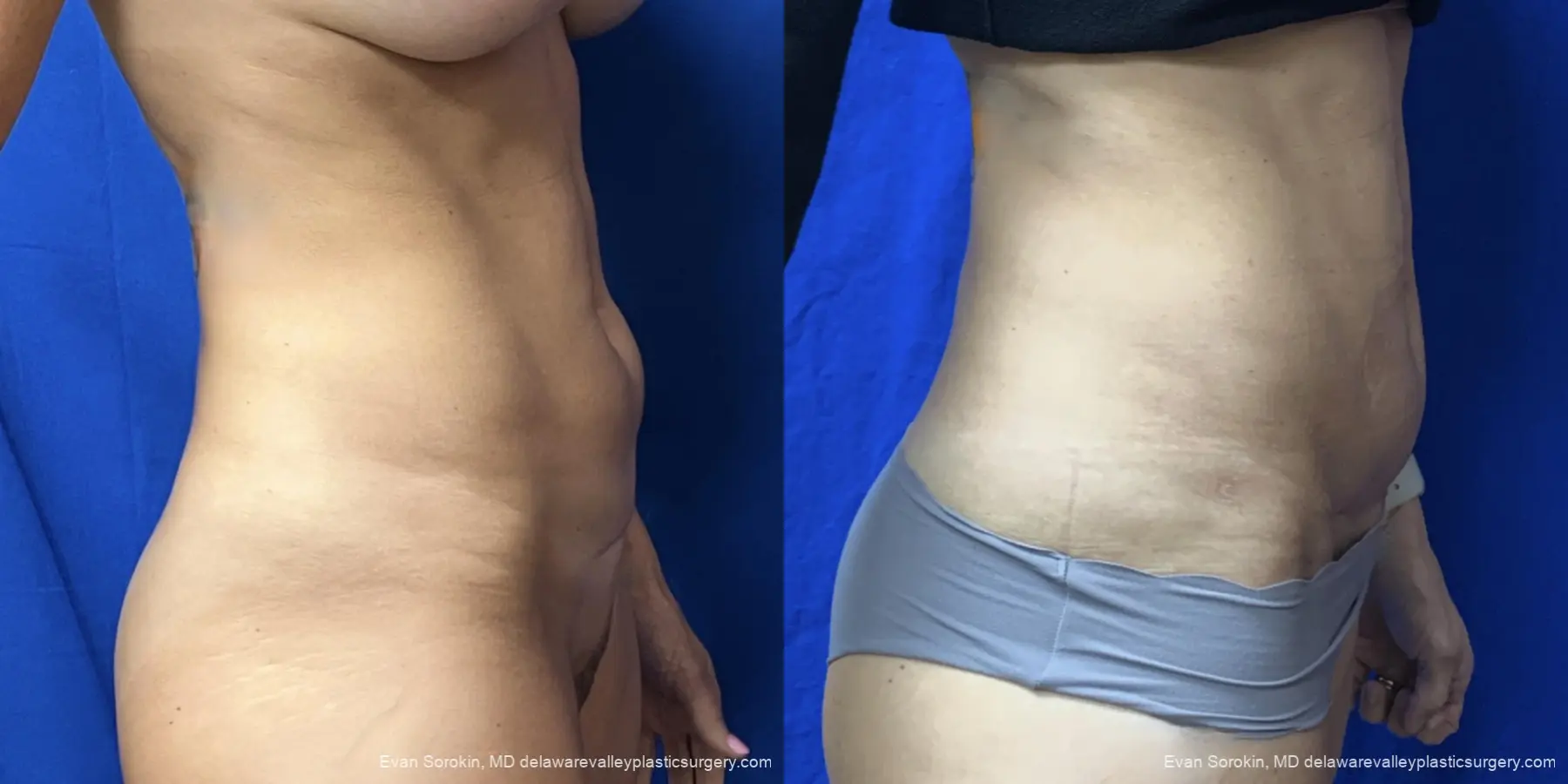 Abdominoplasty: Patient 46 - Before and After 3