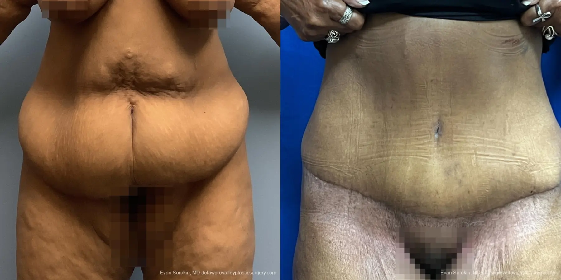 Abdominoplasty: Patient 38 - Before and After 1