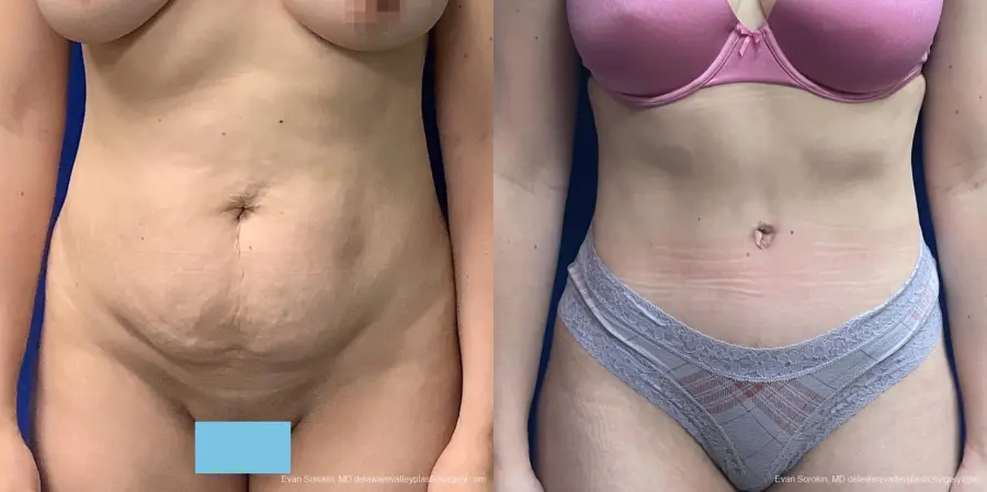 Abdominoplasty: Patient 36 - Before and After 1