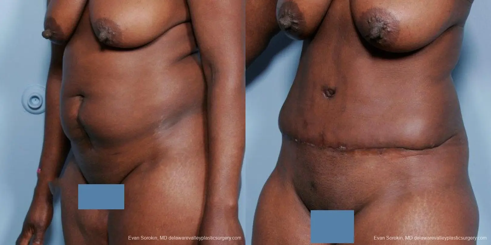 Philadelphia Abdominoplasty 9477 - Before and After 4