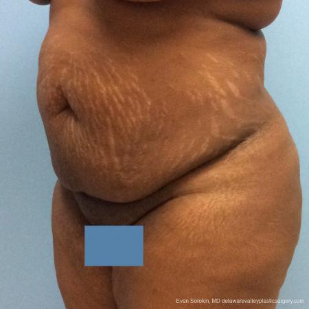 Philadelphia Abdominoplasty 10817 - Before Image 4