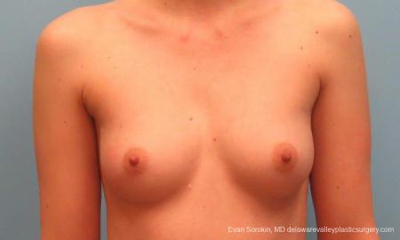 Philadelphia Breast Augmentation 9381 - Before Image 1