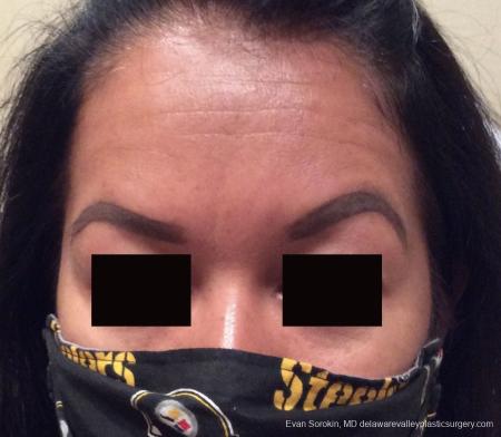 BOTOX® Cosmetic: Patient 1 - After Image 1