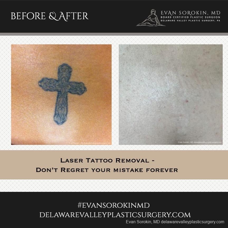 Philadelphia Tattoo Removal 8646 - Before and After Image 1