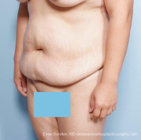 Philadelphia Abdominoplasty 8678 - Before and After Image 3