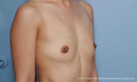 Philadelphia Breast Augmentation 8661 - Before Image 2