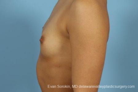 Philadelphia Breast Augmentation 9408 - Before and After Image 5