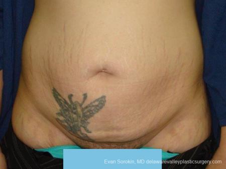 Philadelphia Abdominoplasty 9473 - Before Image 1