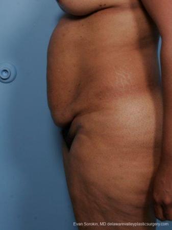 Philadelphia Abdominoplasty 9461 - Before and After Image 5