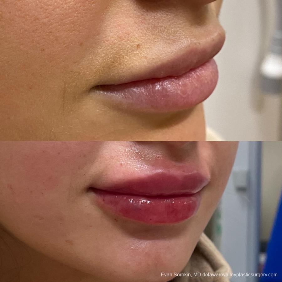 Fillers: Patient 25 - Before and After 2