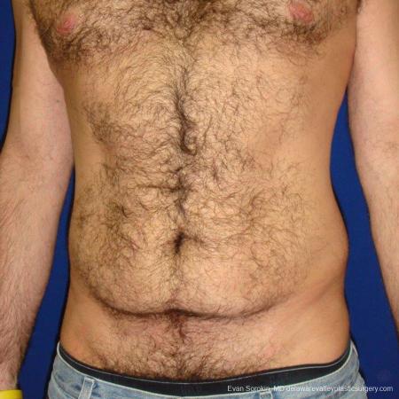 Philadelphia Abdominoplasty 9468 - Before Image 1