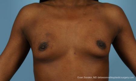 Philadelphia Breast Augmentation 8655 - Before Image 1