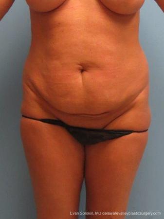 Philadelphia Abdominoplasty 9463 - Before Image 1