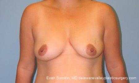 Philadelphia Breast Lift and Augmentation 10123 - Before Image 1