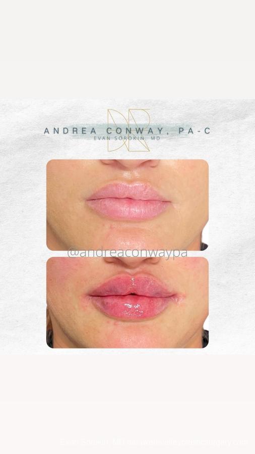 Lip Filler: Patient 51 - Before and After 1